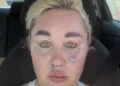 Amanda Bynes showed off fuller lips on Friday after revealing she had lip filler injections.