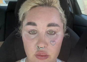 Amanda Bynes showed off fuller lips on Friday after revealing she had lip filler injections.