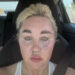 Amanda Bynes showed off fuller lips on Friday after revealing she had lip filler injections.