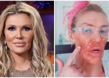 Brandi Glanville Used Nair On Her Face For A Skin Condition