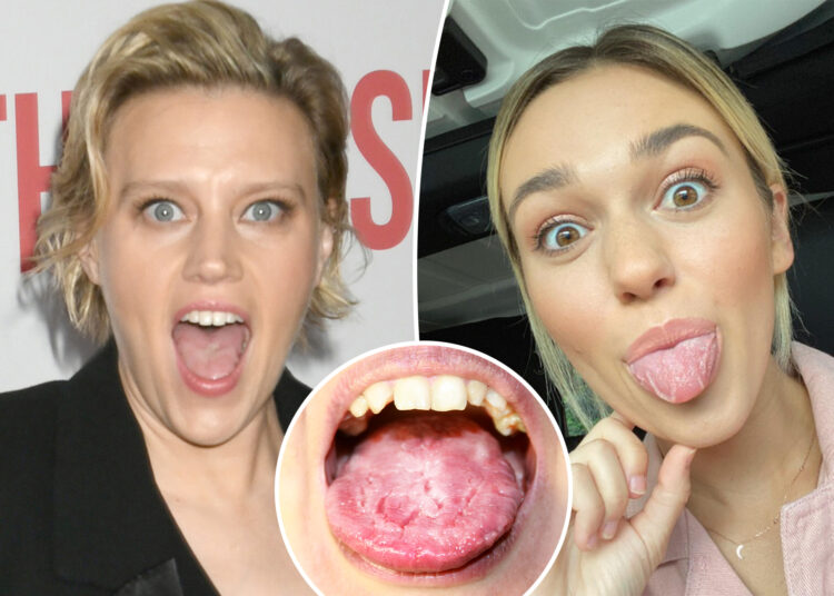 What is 'geographic tongue'? All about 'SNL' star Kate McKinnon's 'gross' condition