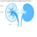 1010 Kidney stones