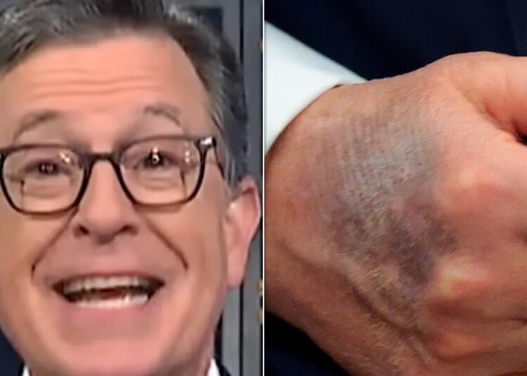 Stephen Colbert Has A Theory About That Bruise On Trump's Hand