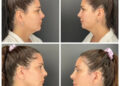 Jennifer Belen Jennifer Belen before her plastic surgery (top) and after (bottom)