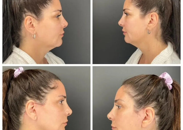 Jennifer Belen Jennifer Belen before her plastic surgery (top) and after (bottom)