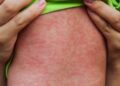 Winkler clinic, Morden entertainment venue among latest measles exposure sites