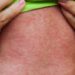 Winkler clinic, Morden entertainment venue among latest measles exposure sites