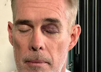 Joe Buck/X Joe Buck shows off his black eye in a selfie