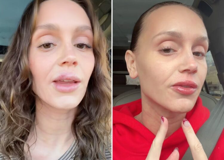 Mormon Wives Mikayla Matthews Dissolves the Rest of Her Lip Filler