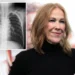 What is dextrocardia? Catherine O'Hara's rare heart condition
