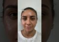 Celebrity Nose | Closed Atraumatic Rhinoplasty