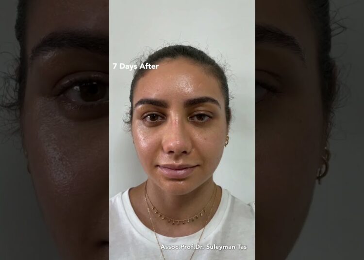 Celebrity Nose | Closed Atraumatic Rhinoplasty