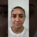 Celebrity Nose | Closed Atraumatic Rhinoplasty