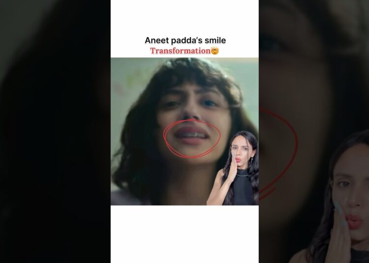 Aneet padda’s smile transformation🤯#shorts#bollywood #aneetpadda#celebrity #transformation#veneers