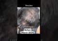 My hair regrowth supplements list that i take daily #hair #hairregrowth #celebrity #hairfall