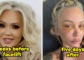 Celebrities Before And After Facelifts