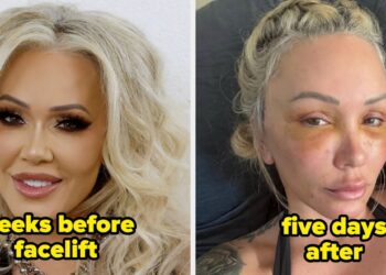 Celebrities Before And After Facelifts