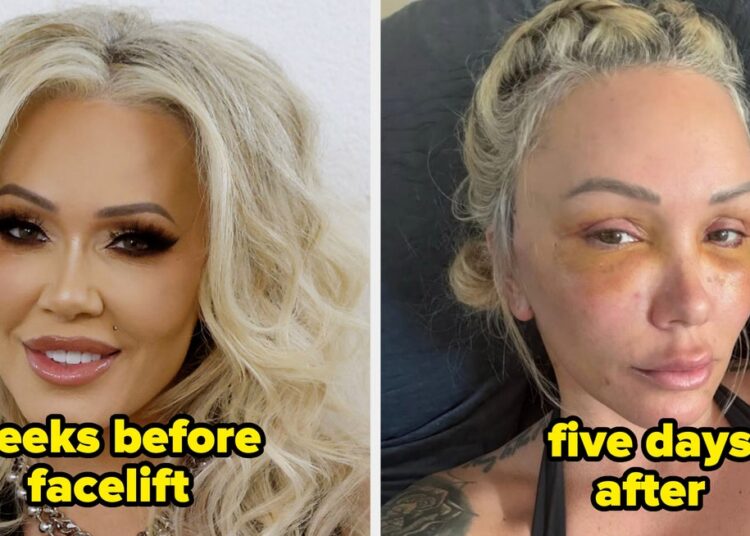 Celebrities Before And After Facelifts