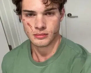 Influencer Clavicular shows a bloody selfie after returning from the hospital on April 15.Credit: Clavicular/X