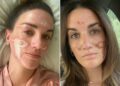 Victoria Nelson's skin scarring after undergoing a chemical treatment by Sonya DakarCredit: Victoria Nelson/TikTok (2)