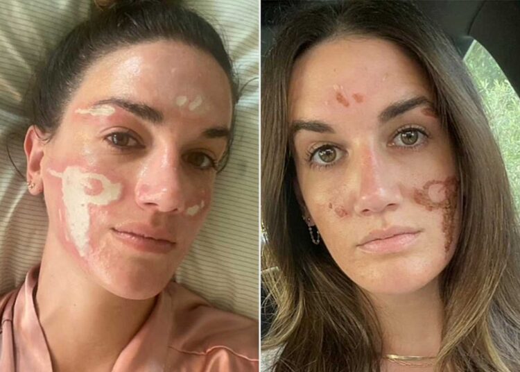 Victoria Nelson's skin scarring after undergoing a chemical treatment by Sonya DakarCredit: Victoria Nelson/TikTok (2)