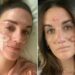 Victoria Nelson's skin scarring after undergoing a chemical treatment by Sonya DakarCredit: Victoria Nelson/TikTok (2)