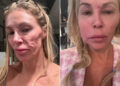 Brandi Glanville showing off her facial disfigurementCredit: BrandiGlanville/X; Brandi Glanville/Instagram