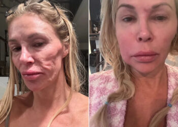 Brandi Glanville showing off her facial disfigurementCredit: BrandiGlanville/X; Brandi Glanville/Instagram