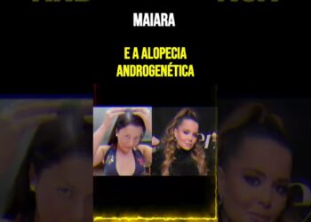Maiara e a alopecia androgenética