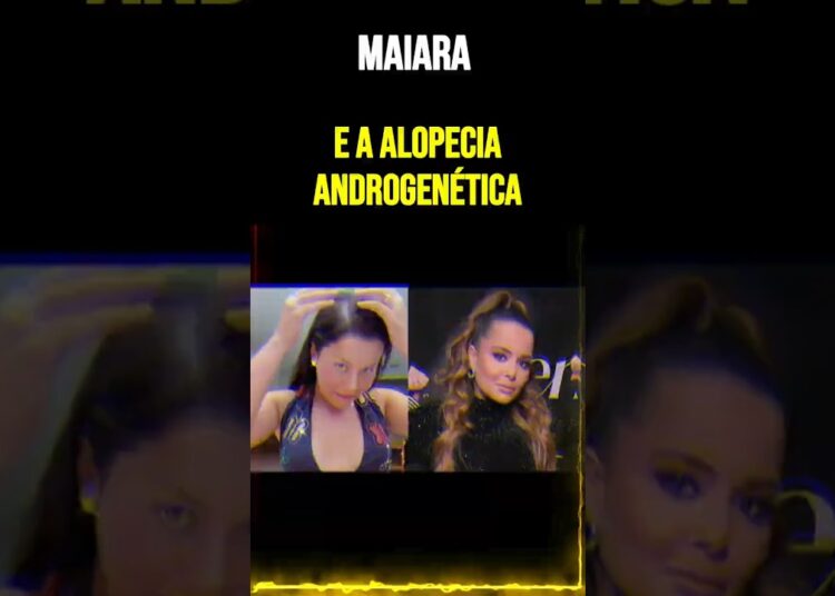Maiara e a alopecia androgenética