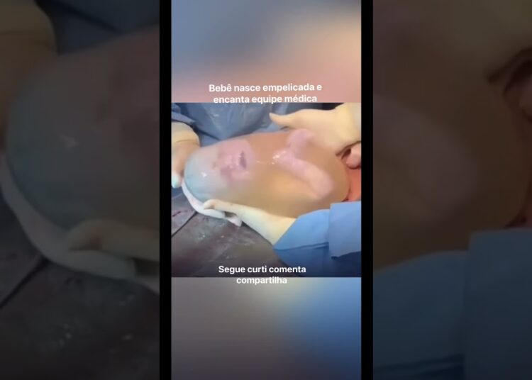 Notícias viral : Bebê nasce empelicada e encanta equipe médica #noticias #fofocas #viralizou #trend