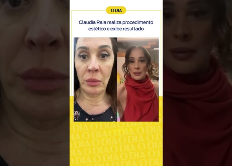 Claudia Raia realiza procedimento estético e exibe resultado | Notícias do Dia