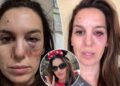 O ex -astro do Disney Channel Christy Carlson Romano faz atualização depois de ser baleado nos olhos