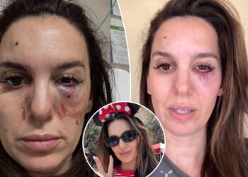 O ex -astro do Disney Channel Christy Carlson Romano faz atualização depois de ser baleado nos olhos