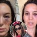 O ex -astro do Disney Channel Christy Carlson Romano faz atualização depois de ser baleado nos olhos
