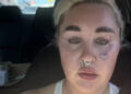 Amanda Bynes revela que recebeu injeções labiais enquanto compartilha um novo visual em selfie de carro