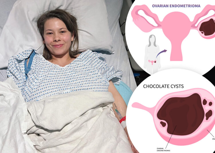 O que é um cisto de chocolate? Bindi Irwin tem crescimento, lensões removidas
