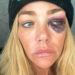 Denise Richards 'lutando pelo tempo da tela' e ordenhando seu divórcio bagunçado enquanto filmava 'RHOBH'