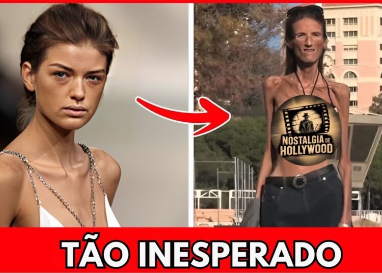 7 Celebridades que Você Não Vai Acreditar que Morreram de Anorexia: Uma Revelação Devastadora!