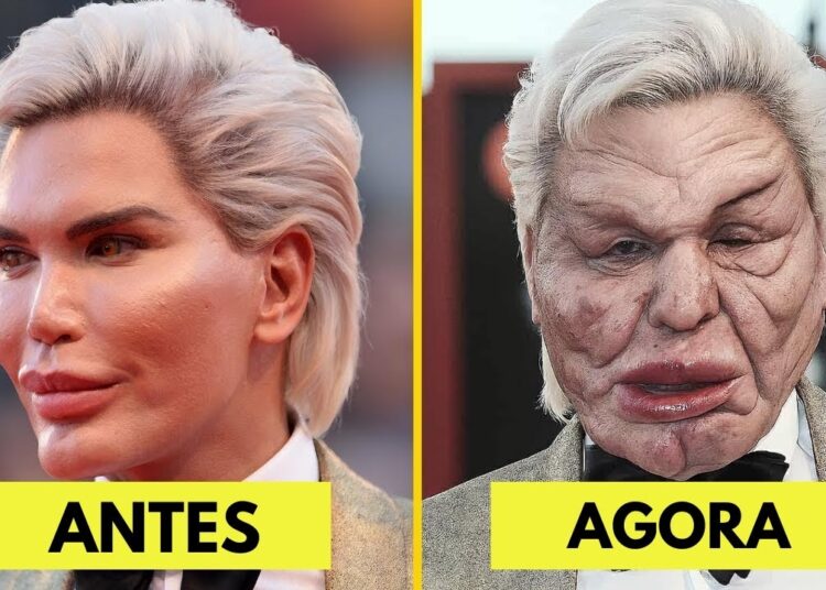 7 Desastres de Cirurgia Plástica de Celebridades que Você Nem Acredita que São Reais Hoje