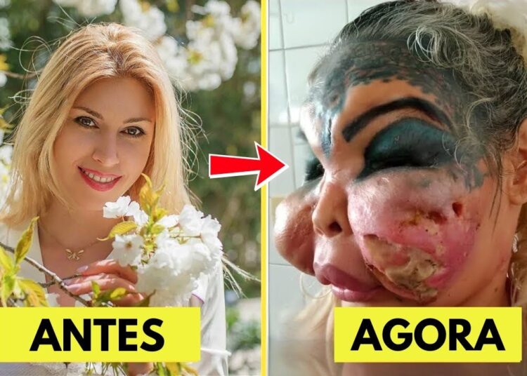 15 Cirurgias Plásticas de Celebridades Que Deram Errado e Vão Te Chocar | Antes e Depois 2025