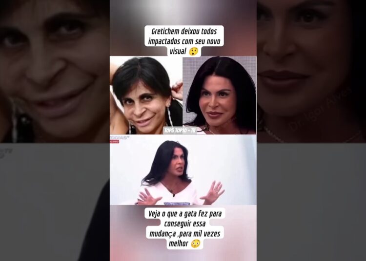 ✨ Gretchen Choca a Todos com Nova Harmonização Facial: “Deu a Volta por Cima!” 😱🔥