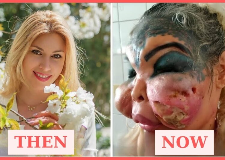 Unbelievable! 21 Stars Who Completely Ruined Their Faces With Plastic Surgery Disasters