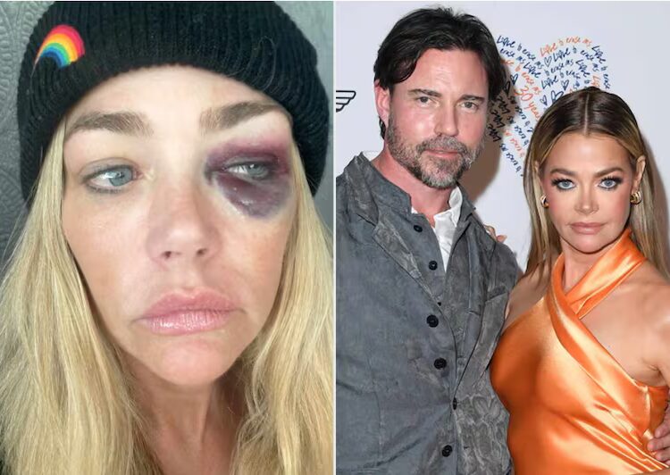 Denise Richards compartilha imagens de suposta violência doméstica do ex-marido Aaron Phypers em novos documentos judiciais.