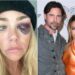 Denise Richards compartilha imagens de suposta violência doméstica do ex-marido Aaron Phypers em novos documentos judiciais.