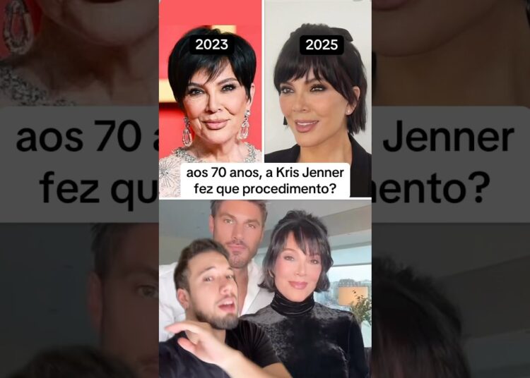 Kris Jenner – Antes e Depois #harmonizacaofacial #liftingfacial #krisjenner #kardashians #famosos