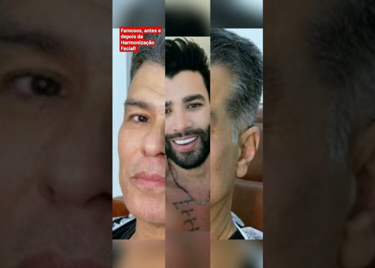 10 famosos antes e depois da Harmonização Facial. Incrível!    #shorts #famosos