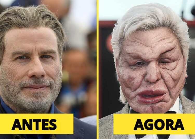 7 Cirurgias Plásticas de Celebridades que Arruinaram Suas Carreiras | Antes e Depois 2025