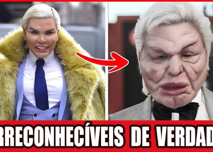 10 Cirurgias Plásticas Que Fizeram Celebridades Perderem O Próprio Rosto (Choque Total!)