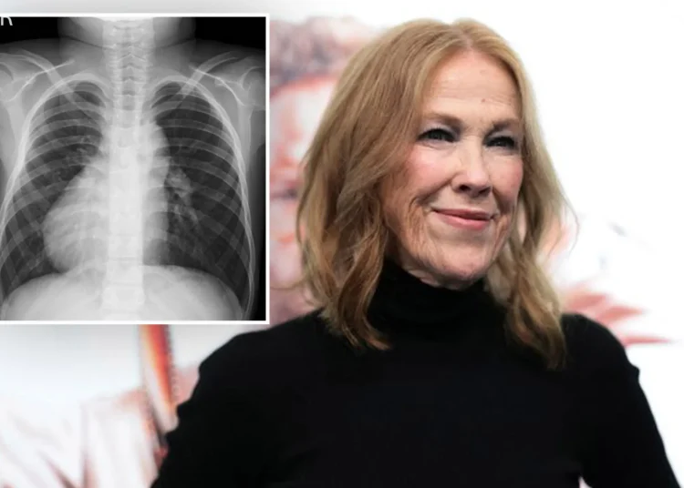 O que é dextrocardia? A rara doença cardíaca de Catherine O'Hara